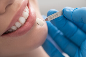 dental veneers glendale
